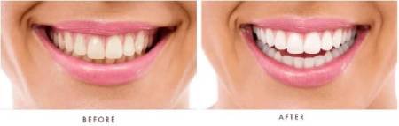 denta-vive-before-after-wellness-gums-bright